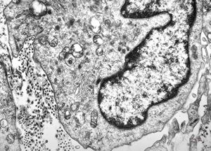 M, 7m. | histiocytosis X (eosinophilic granuloma) … Langerhans cell M, 7m. | histiocytosis X (eosinophilic granuloma) … Langerhans cell